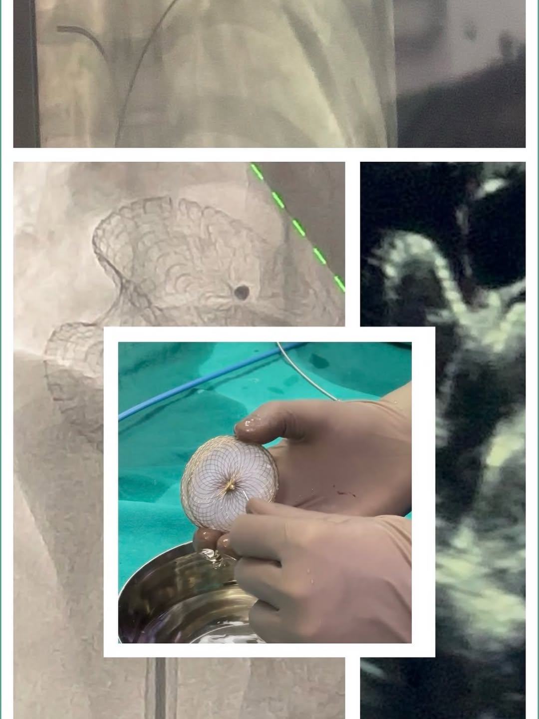 How ASD Device Closure Works — A Look at the Device and How It Sits Inside the Heart — image 1