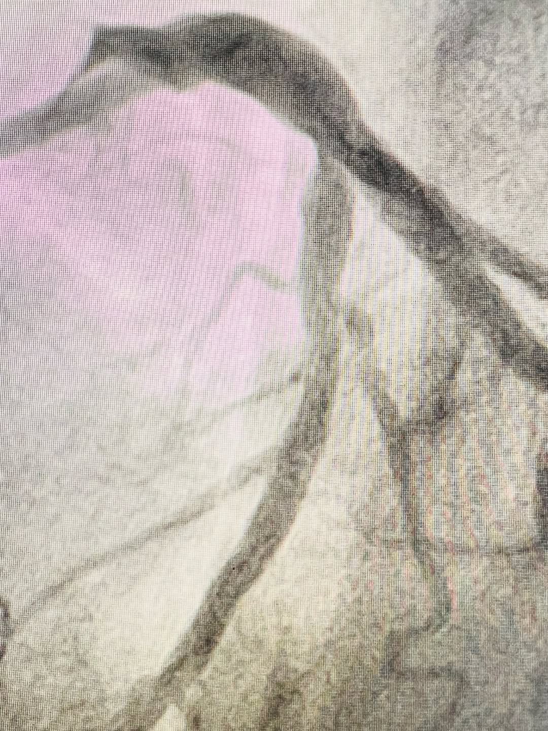How OCT Imaging Prevented an Unnecessary Heart Procedure — A Case from Rajkot — image 2