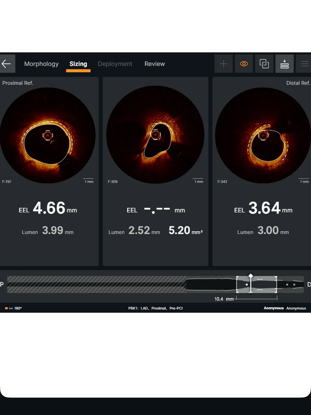 How OCT Imaging Prevented an Unnecessary Heart Procedure — A Case from Rajkot — image 3