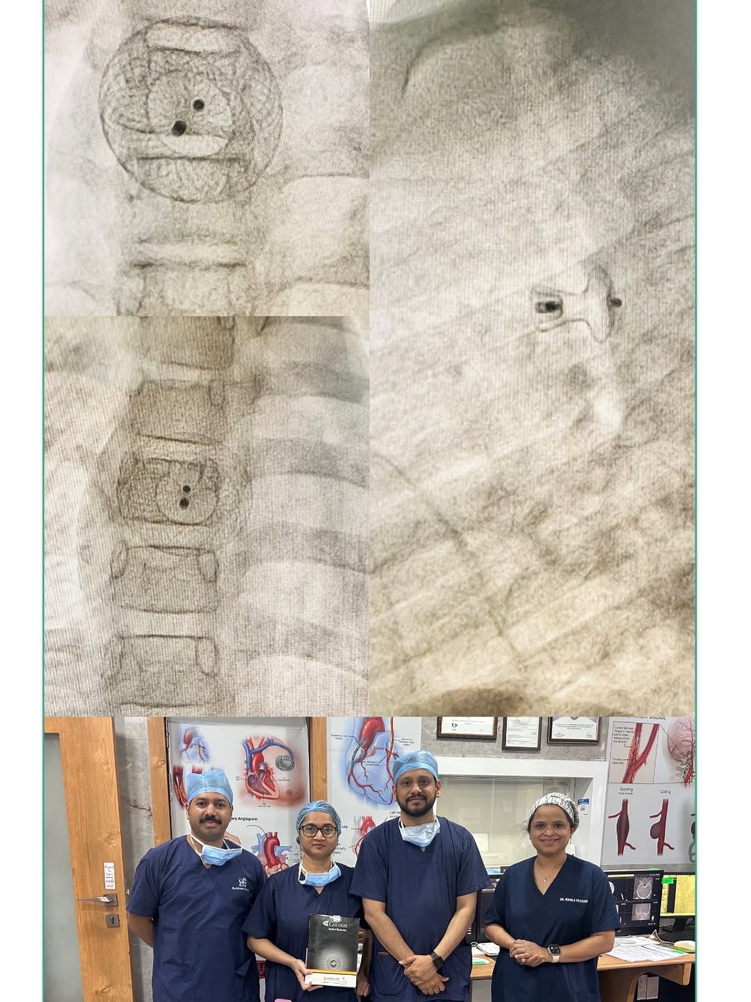 Pediatric Heart Defect Closures — ASD, PDA & Fenestrated ASD Treated at Backbone Medicity, Rajkot — image 1