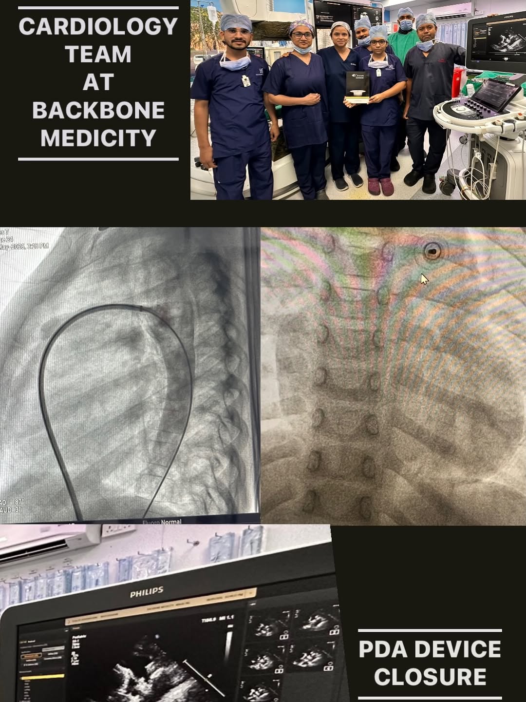 Successful PDA Device Closure in a 3-Year-Old Child at Backbone Medicity Hospital, Rajkot — image 1
